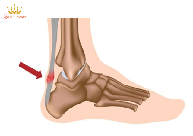 chấn thương khi chạy bộ